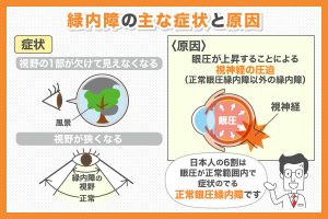 緑内障の主な症状と原因