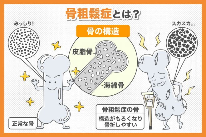 小児期に骨粗鬆症を患った人の今後の見通しはどうなるのでしょうか?