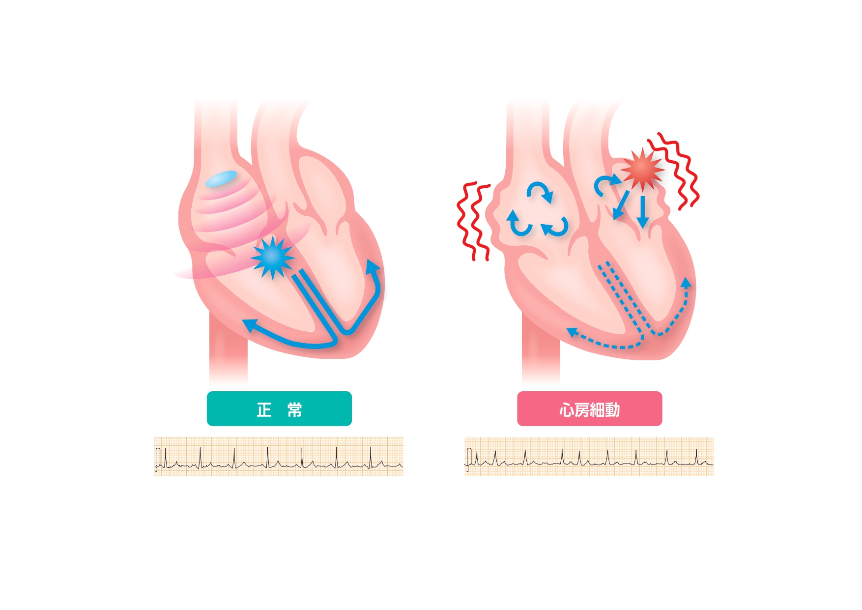 心房細動の気になる症状とは