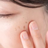 シミを消す方法｜原因から自宅ケア・医療治療まで徹底解説