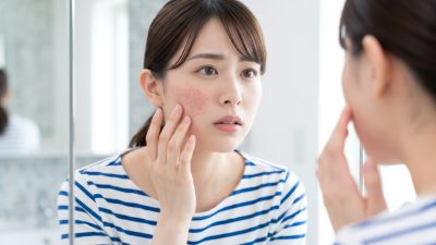酒さは一生治らない？その真実と向き合い方を徹底解説