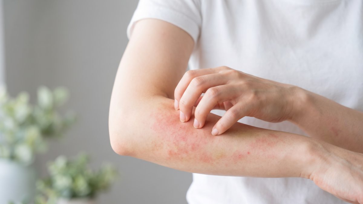アトピー性皮膚炎を徹底解説！症状・原因・治療法から日常生活の対策まで