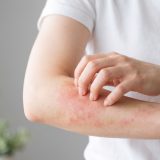 アトピー性皮膚炎を徹底解説！症状・原因・治療法から日常生活の対策まで