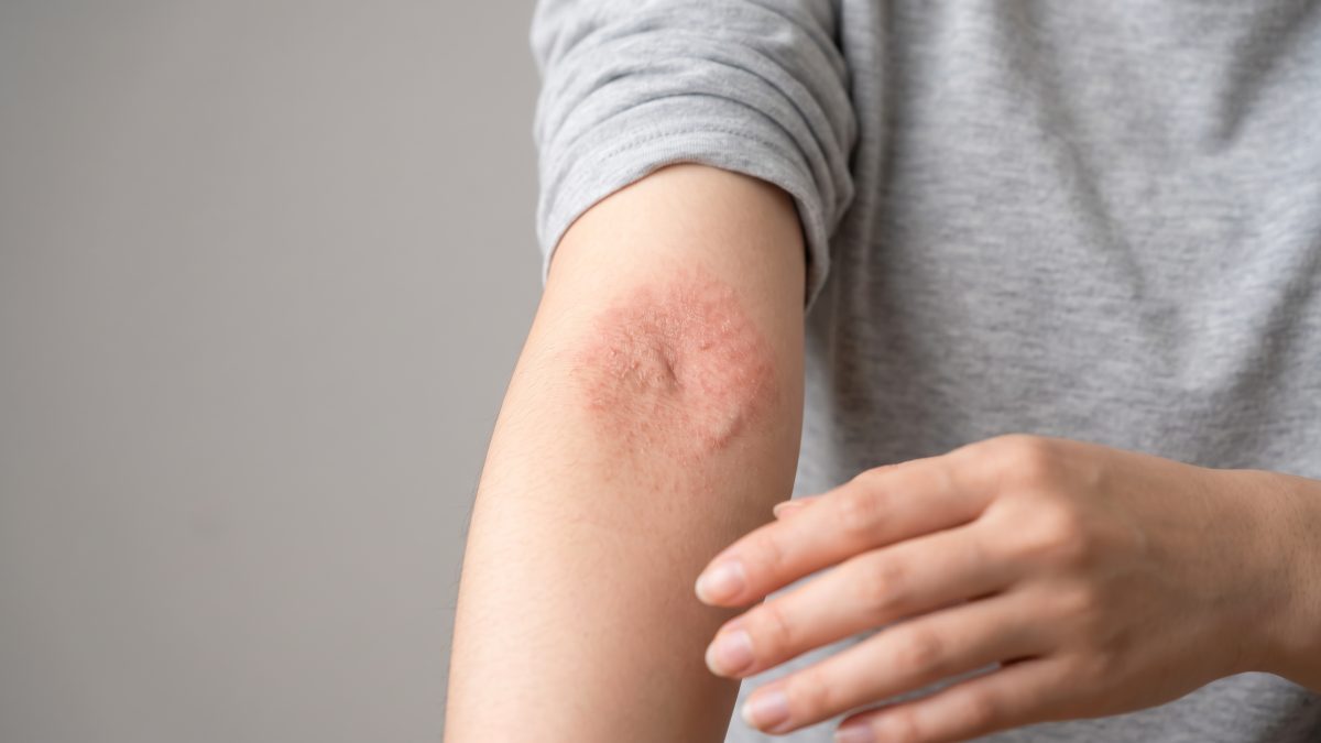 アトピー性皮膚炎の治し方｜症状を改善する薬と生活習慣の全知識