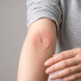 アトピー性皮膚炎の治し方｜症状を改善する薬と生活習慣の全知識