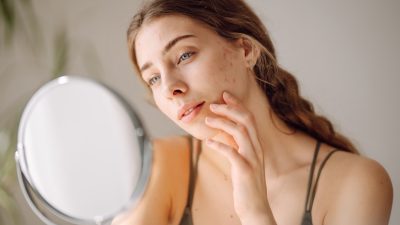 【皮膚科医監修】ニキビの原因から治療法まで完全ガイド