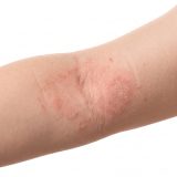 アトピー性皮膚炎を大人になって発症：原因と対策を解説
