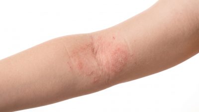 アトピー性皮膚炎を大人になって発症：原因と対策を解説