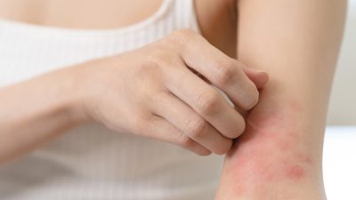 蕁麻疹(じんましん)を掻くと広がるのはなぜ？原因と対策を解説