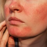 アトピーによる顔の赤みを抑える方法｜セルフケア・皮膚科治療を解説