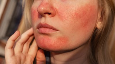アトピーによる顔の赤みを抑える方法｜セルフケア・皮膚科治療を解説
