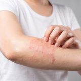 子どものアトピー完全ガイド｜年齢別の症状、正しいスキンケアと薬の使い方まで