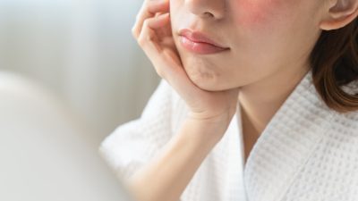 赤ら顔の治し方完全ガイド！原因から皮膚科治療まで解説