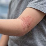子どもの蕁麻疹に悩む方必見！受診目安と家庭でのケア完全ガイド