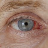 白内障になりやすい人の8つの特徴とは？年齢・生活習慣・持病のリスクと予防法を徹底解説