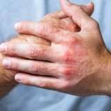 全身性エリテマトーデス（SLE）と突然死：リスク、主な原因、そして希望ある対策