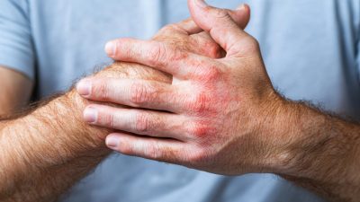 全身性エリテマトーデス（SLE）と突然死：リスク、主な原因、そして希望ある対策