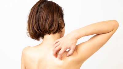 かゆみや湿疹はマラセチアアレルギーかも？原因・症状・治療法を徹底解説