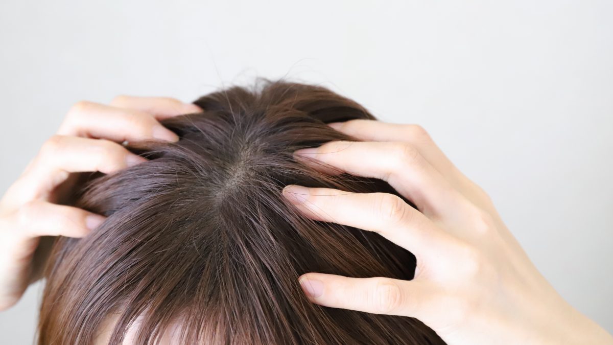 脂漏性皮膚炎で頭皮にかさぶたができる原因は？正しい治し方と剥がしてはいけない理由