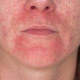 【顔の脂漏性皮膚炎】赤み・フケの症状・原因から自宅でできる治し方・対策まで徹底解説