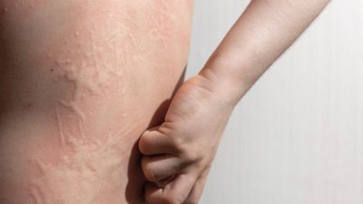 子供の蕁麻疹はストレスが原因？見抜き方と家庭でできるケアのポイント