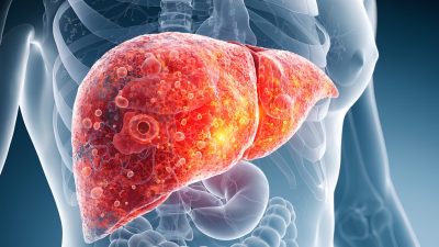 脂肪肝で「お腹が出る」本当の理由とは？内臓脂肪・腹水・肝腫大のメカニズムと改善策