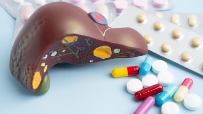 脂肪肝を早く治す行動計画｜最短で改善を目指す食事・運動・生活習慣