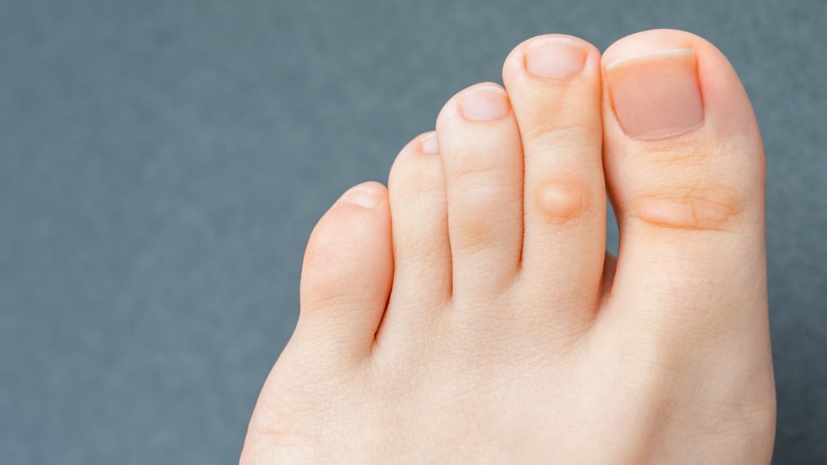 爪の横を押すと痛いのはなぜ？主な原因と症状別の鑑別ポイント・対処法