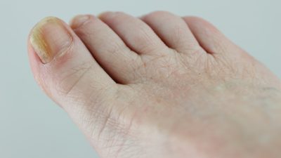 爪が白く濁る原因は？爪白癬・カンジダから全身の病気のサインまで
