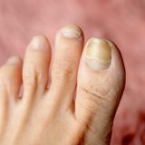 爪水虫の末期は治る？重症化のサインと治療期間の目安、自分で削る危険性