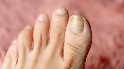 爪水虫の末期は治る？重症化のサインと治療期間の目安、自分で削る危険性