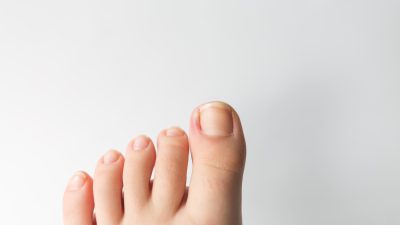 足の爪の変色は何が原因？黒・白・黄色・緑の色別に見分け方と受診の目安